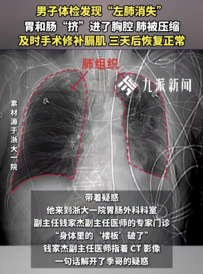 男子中奖获体检 发现左肺不见了? 男子中奖获体检 发现左肺不见了?