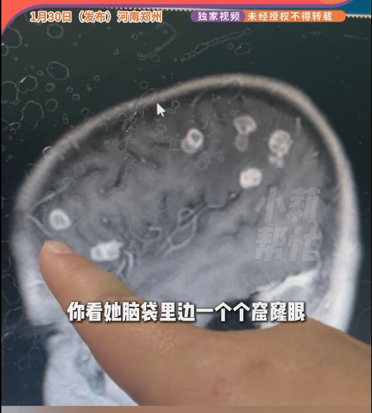 河南6岁女孩脑子被“啃”20个洞 原因竟是… 河南6岁女孩脑子被“啃”20个洞 原因竟是…