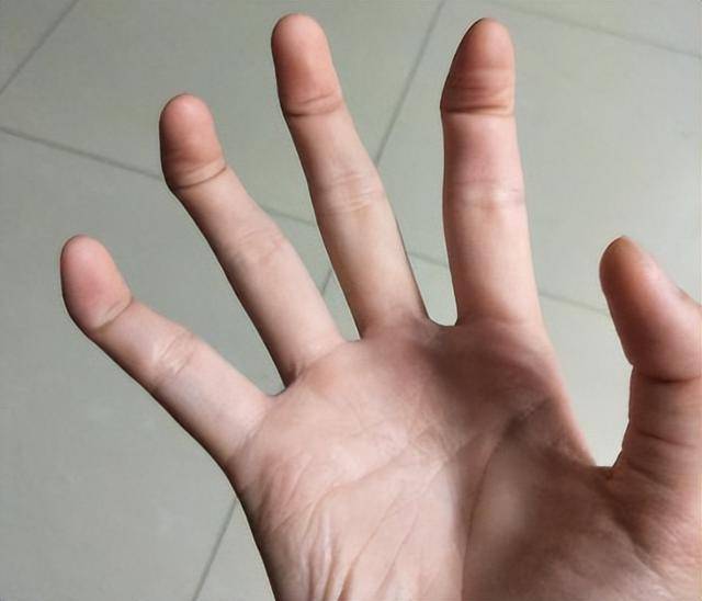 10种罕见的人体特征,拥有一个或是“天选之人” 10种罕见的人体特征,拥有一个或是“天选之人”