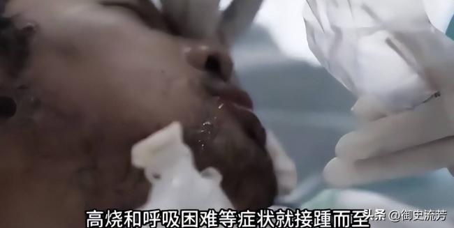 武汉首批新冠重症幸存者,6年后现状如何 武汉首批新冠重症幸存者,6年后现状如何